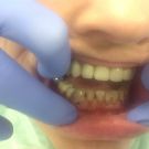Pacjentka przed wykonaniem licówek kompozytowych w zębach dolnych