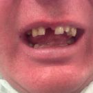 Pacjent z brakami uzębienia i mocno startymi zębami przed wykonaniem pracy protetycznej