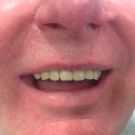 Pacjent po wykonaniu protezy acronowej uzupełniającej braki zębowe oraz po odbudowaniu startych zębów materiałem kompozytowym